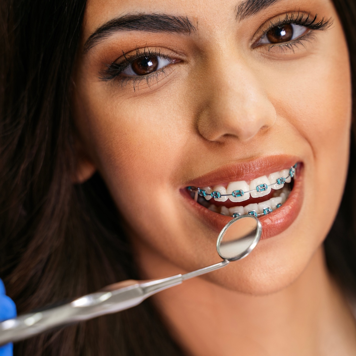 How Long Do You Need to Have Houston Braces?